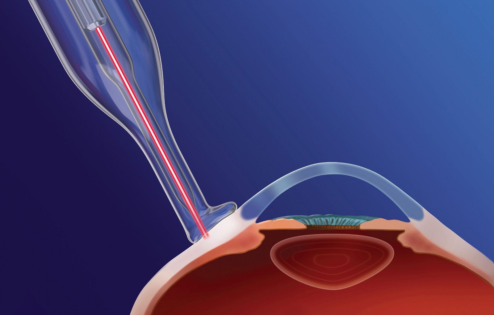 Advanced Glaucoma Care