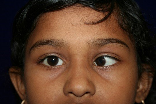 Squint Surgery